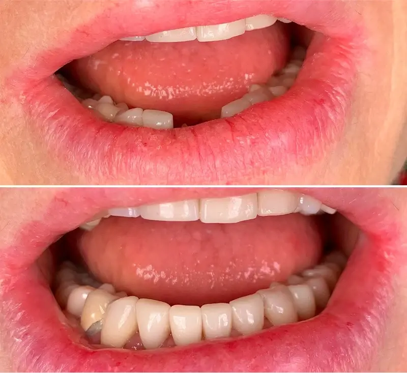 Canyon Rim Dental dental crowns result — Salt Lake City, UT