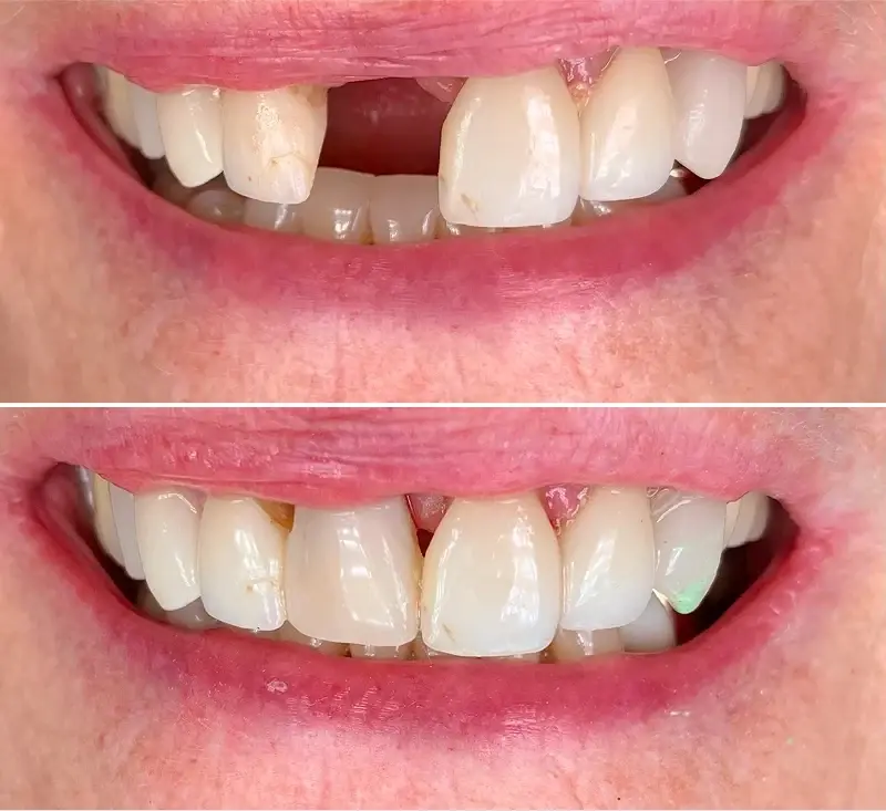 Canyon Rim Dental dental implants result — Salt Lake City, UT