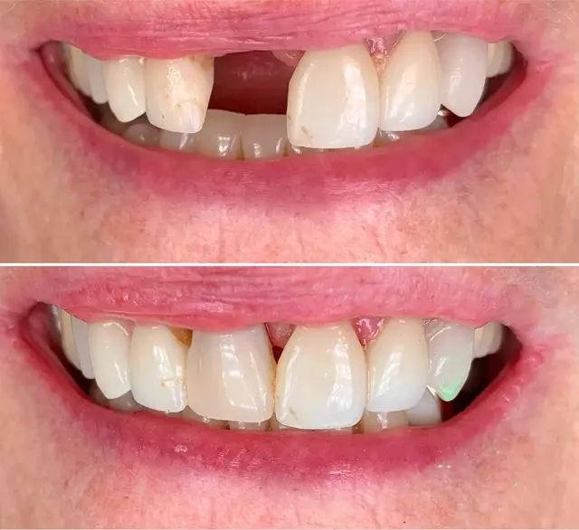Dental Implants result at Canyon Rim Dental in Salt Lake City, UT