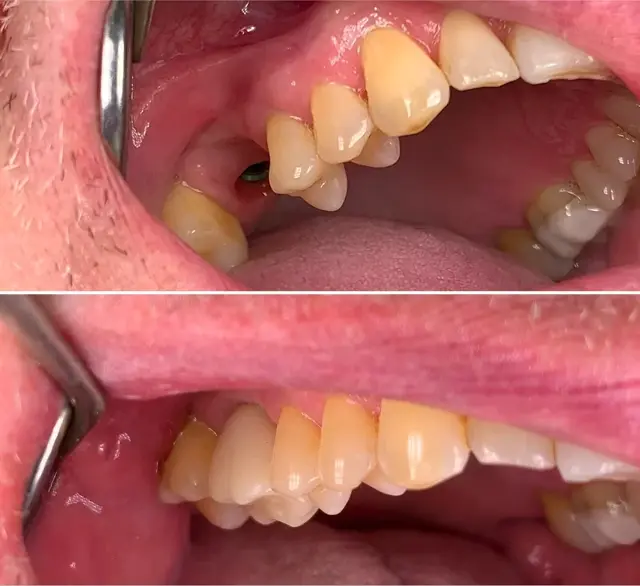 Dental Implants result at Canyon Rim Dental in Salt Lake City, UT
