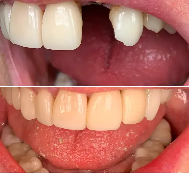 Dental Crowns result at Canyon Rim Dental in Salt Lake City, UT