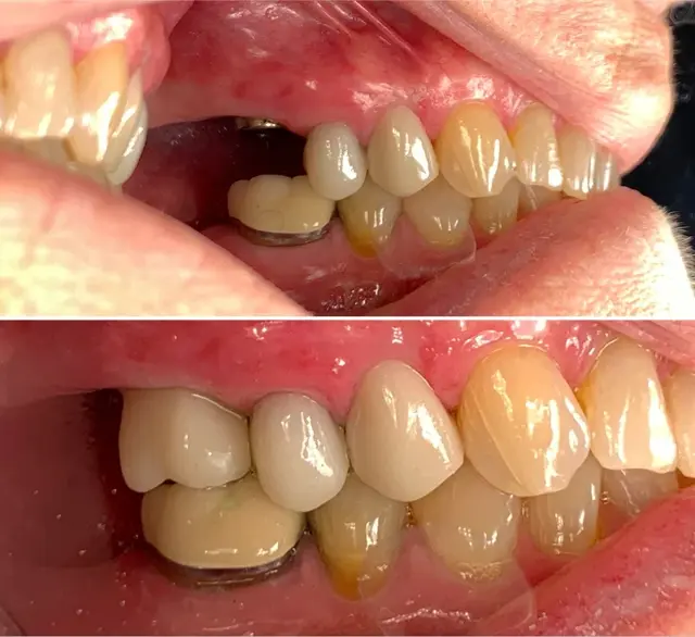 Dental Implants result at Canyon Rim Dental in Salt Lake City, UT