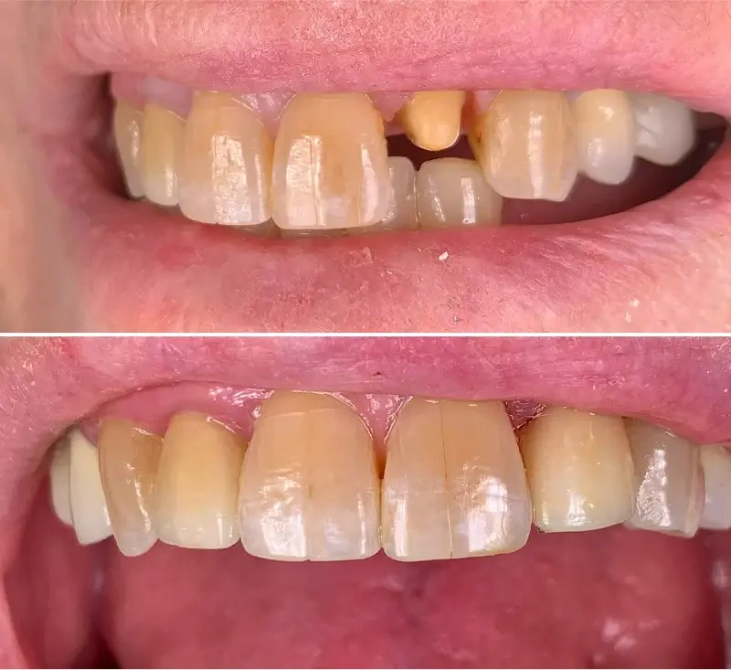 Canyon Rim Dental dental crowns result — Salt Lake City, UT