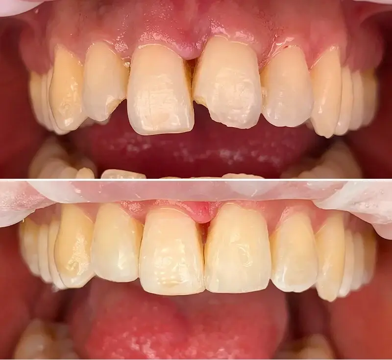 Canyon Rim Dental dental bonding result — Salt Lake City, UT