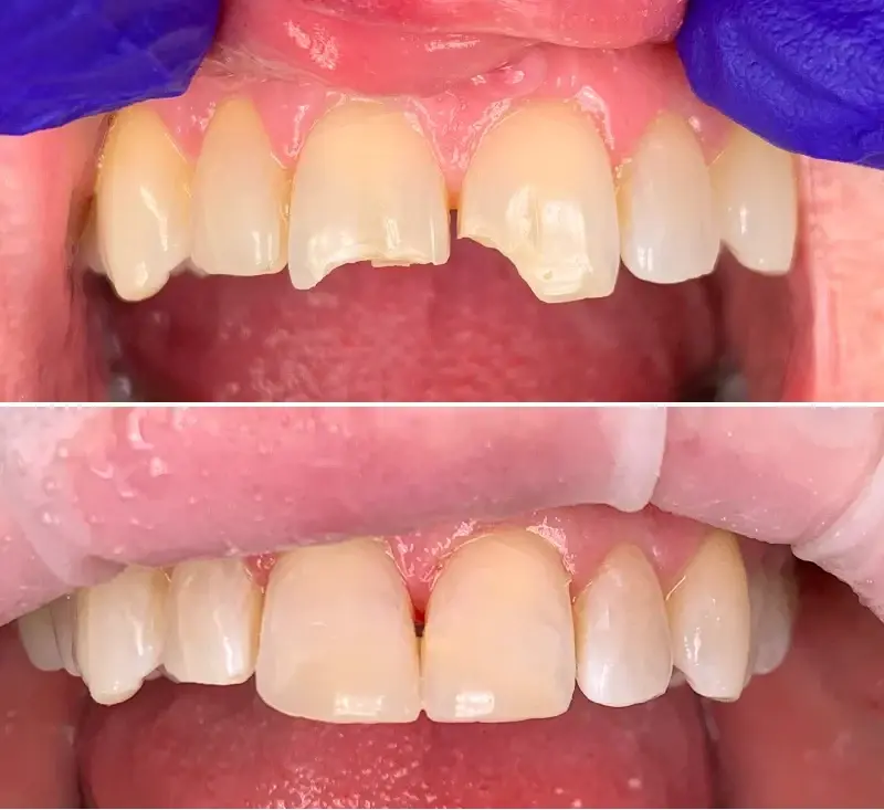 Canyon Rim Dental dental bonding result — Salt Lake City, UT