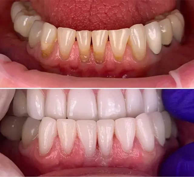 Smile Makeover result at Canyon Rim Dental in Salt Lake City, UT