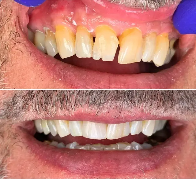 Dental Veneers result at Canyon Rim Dental in Salt Lake City, UT