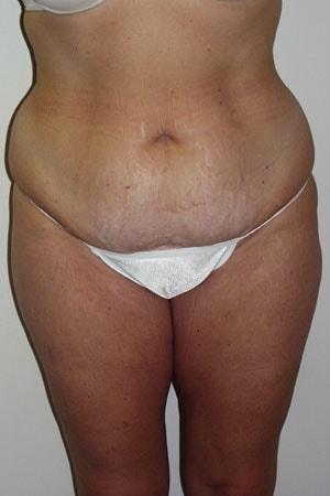 Mini Tummy Tuck before at Tuan A Vu, MD in Sugar Land, TX