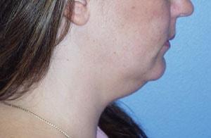 Neck Liposuction before at Tuan A Vu, MD in Sugar Land, TX
