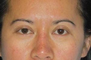Blepharoplasty before at Tuan A Vu, MD in Sugar Land, TX