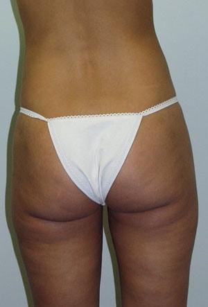 Tuan A Vu, MD liposuction after — Sugar Land, TX