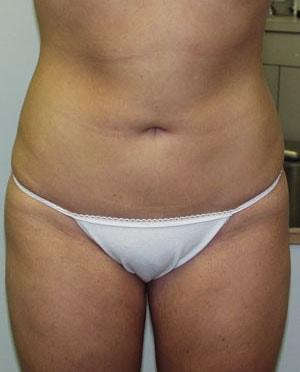 Liposuction after at Tuan A Vu, MD in Sugar Land, TX