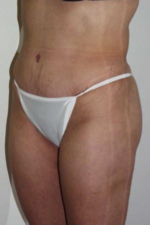 Mini Tummy Tuck after at Tuan A Vu, MD in Sugar Land, TX