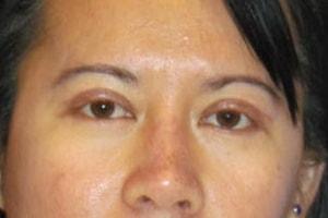 Blepharoplasty after at Tuan A Vu, MD in Sugar Land, TX