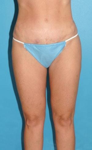 Tuan A Vu, MD liposuction after — Sugar Land, TX