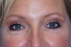 Blepharoplasty after at Tuan A Vu, MD in Sugar Land, TX