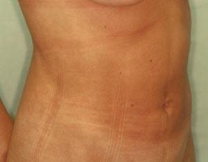 Tuan A Vu, MD liposuction after — Sugar Land, TX