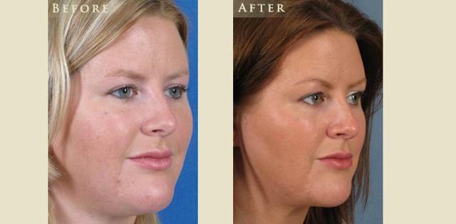 Facelift result at Colorado Plastic Surgery in Denver, CO