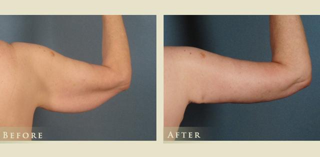 Arm Lift result at Colorado Plastic Surgery in Denver, CO