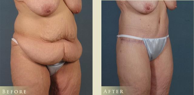 Thigh Lift result at Colorado Plastic Surgery in Denver, CO