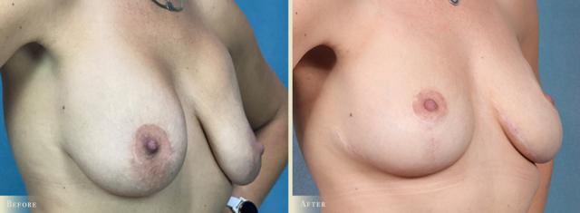 Fat Transfer result at Colorado Plastic Surgery in Denver, CO