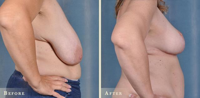 Breast Reduction result at Colorado Plastic Surgery in Denver, CO