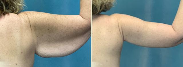 Arm Lift result at Colorado Plastic Surgery in Denver, CO