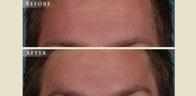 Botox result at Colorado Plastic Surgery in Denver, CO