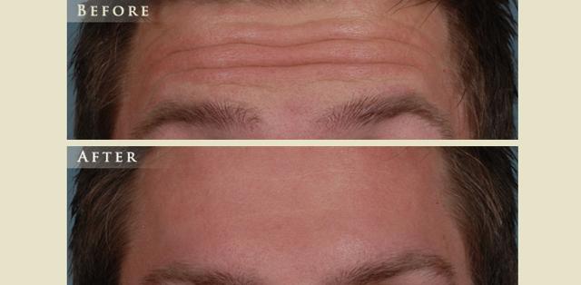 Botox result at Colorado Plastic Surgery in Denver, CO