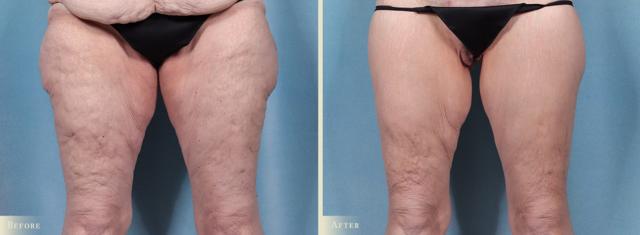 Thigh Lift result at Colorado Plastic Surgery in Denver, CO