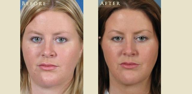 Facelift result at Colorado Plastic Surgery in Denver, CO