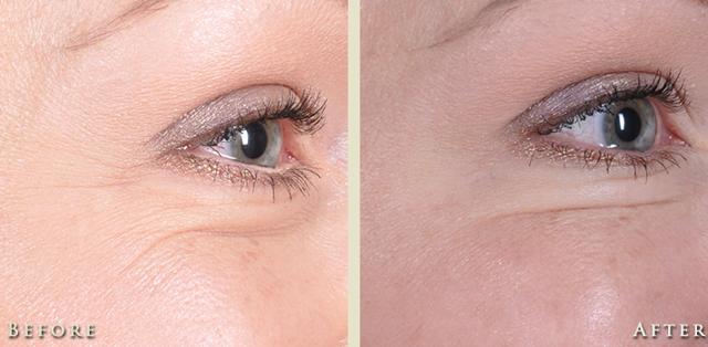 Botox result at Colorado Plastic Surgery in Denver, CO