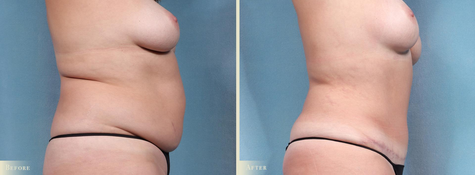 Colorado Plastic Surgery tummy tuck result — Denver, CO