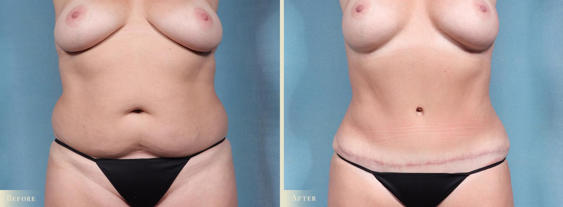 Colorado Plastic Surgery tummy tuck result — Denver, CO
