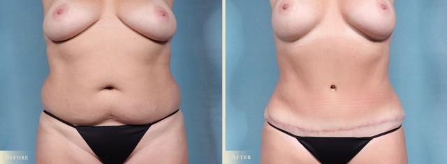 Tummy Tuck result at Colorado Plastic Surgery in Denver, CO
