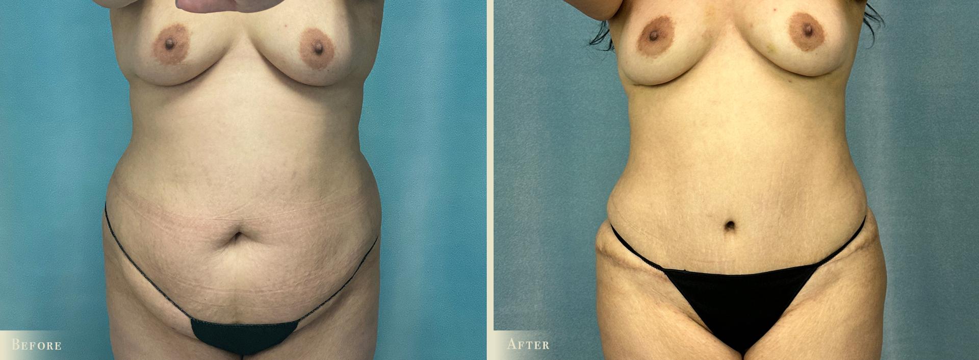 Colorado Plastic Surgery tummy tuck result — Denver, CO