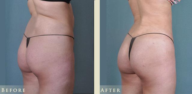 Brazilian Butt Lift result at Colorado Plastic Surgery in Denver, CO