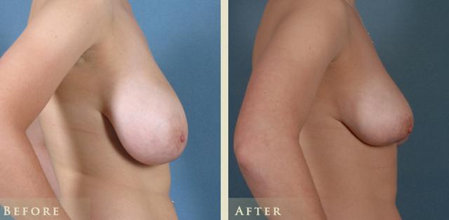 Breast Reduction result at Colorado Plastic Surgery in Denver, CO