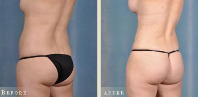 Brazilian Butt Lift result at Colorado Plastic Surgery in Denver, CO
