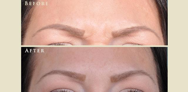 Botox result at Colorado Plastic Surgery in Denver, CO