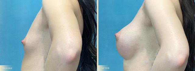 Breast Augmentation result at Colorado Plastic Surgery in Denver, CO