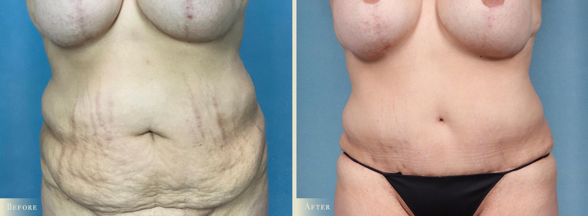 Colorado Plastic Surgery tummy tuck result — Denver, CO