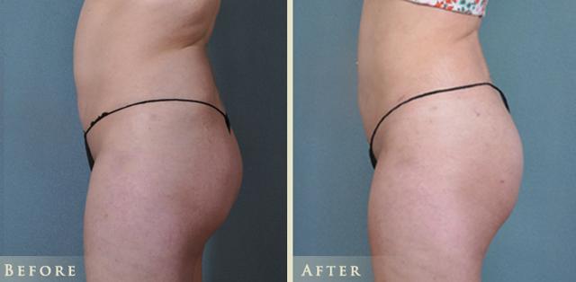 Brazilian Butt Lift result at Colorado Plastic Surgery in Denver, CO