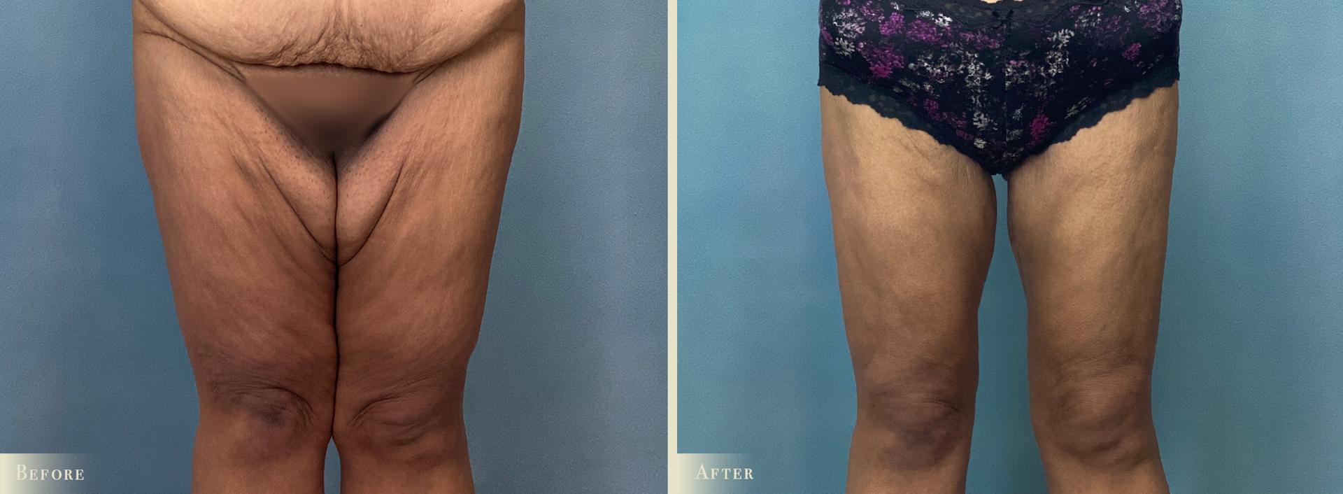 Colorado Plastic Surgery thigh lift result — Denver, CO