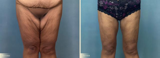 Thigh Lift result at Colorado Plastic Surgery in Denver, CO