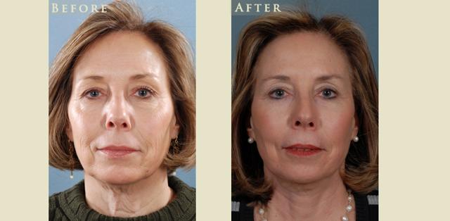 Facelift result at Colorado Plastic Surgery in Denver, CO