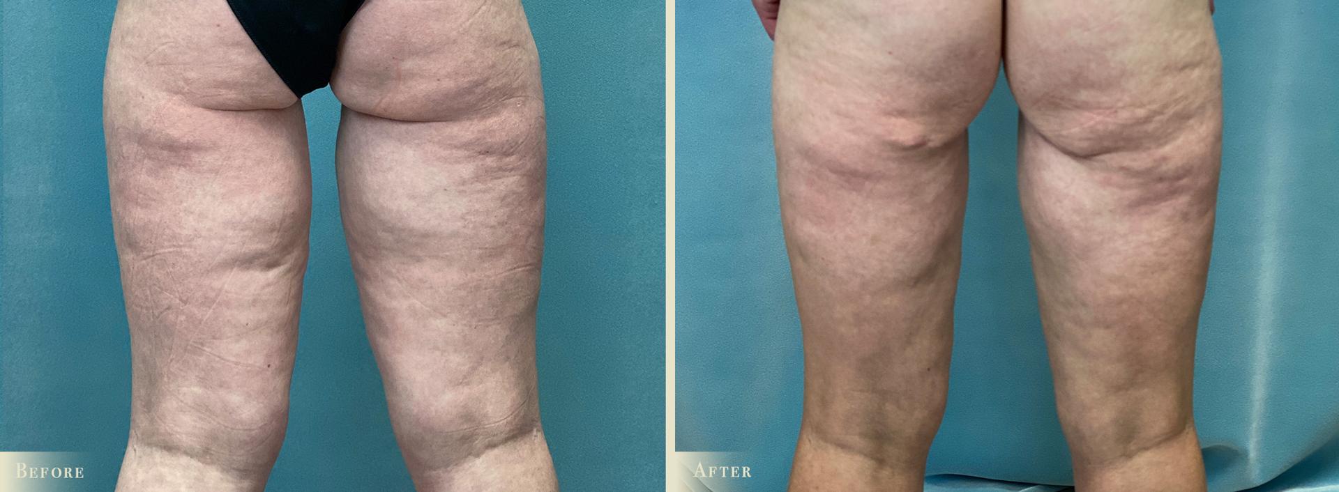 Colorado Plastic Surgery thigh lift result — Denver, CO