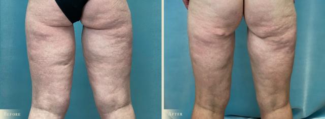 Thigh Lift result at Colorado Plastic Surgery in Denver, CO