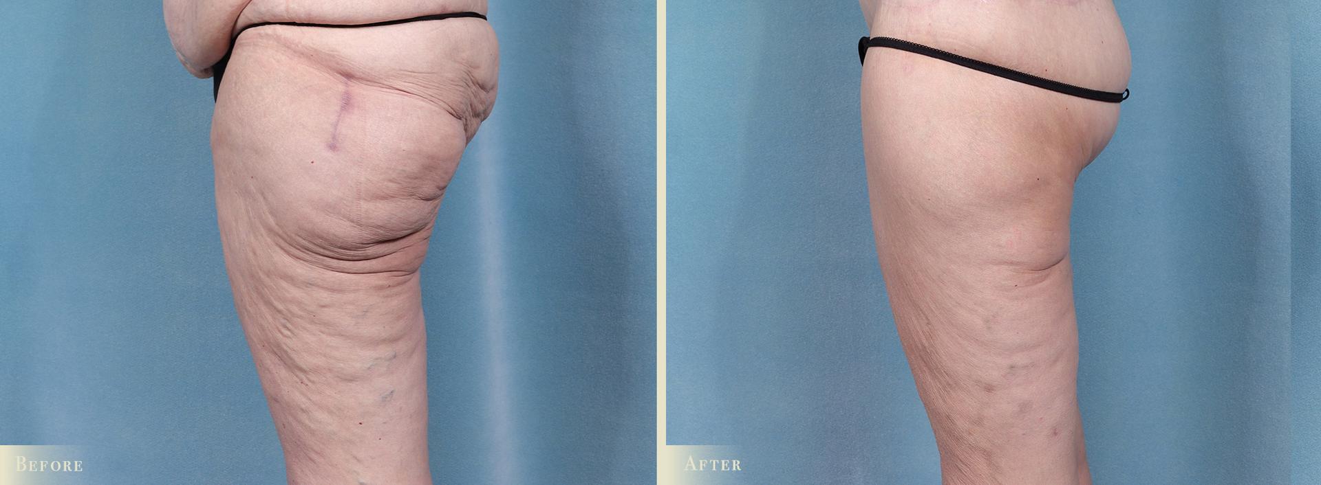 Colorado Plastic Surgery thigh lift result — Denver, CO