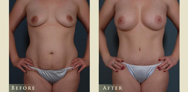 Mommy Makeover result at Colorado Plastic Surgery in Denver, CO